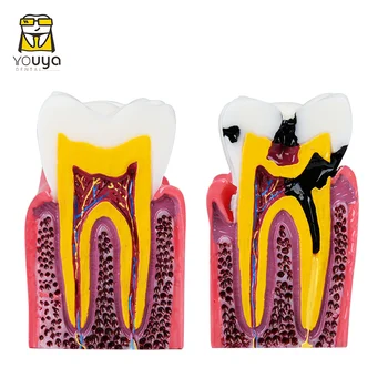 6 Gange Dental Modeller Molar Patologisk Anatomiske Sammenligning Model Til At Fremme Studiet Af Tooth-Struktur Og Proces Læsion