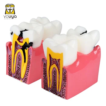 6 Gange Dental Modeller Molar Patologisk Anatomiske Sammenligning Model Til At Fremme Studiet Af Tooth-Struktur Og Proces Læsion