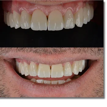 ST+Farve pre-skraverede 98mm(22mm tykkelse) --Beautyzir høj gennemskinnelighed dental zirkonia blokere for Roland cad-cam maskine