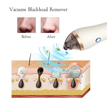 El-Pore Bums Remover Hudorm Remover Vakuum Emhætte Hudpleje Acne Suge Stedet Facial Hud Cupping Sæbe Remover