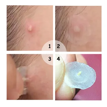 MJ Hydrocolloid Acne Usynlige Bums Master Patch Hud Tag Fjernelse Patch Bums /Hudorm Plet Fjernelse Facial Care Tool